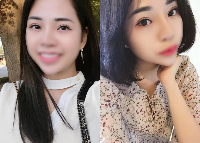 Mở rộng khoé mắt - xu hướng phẫu thuật 2018 đã lan rộng đến việt nam như thế nào