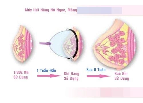 Tám chuyện dao kéo nâng ngực bằng máy hút không mổ xẻ hiệu quả tức thì