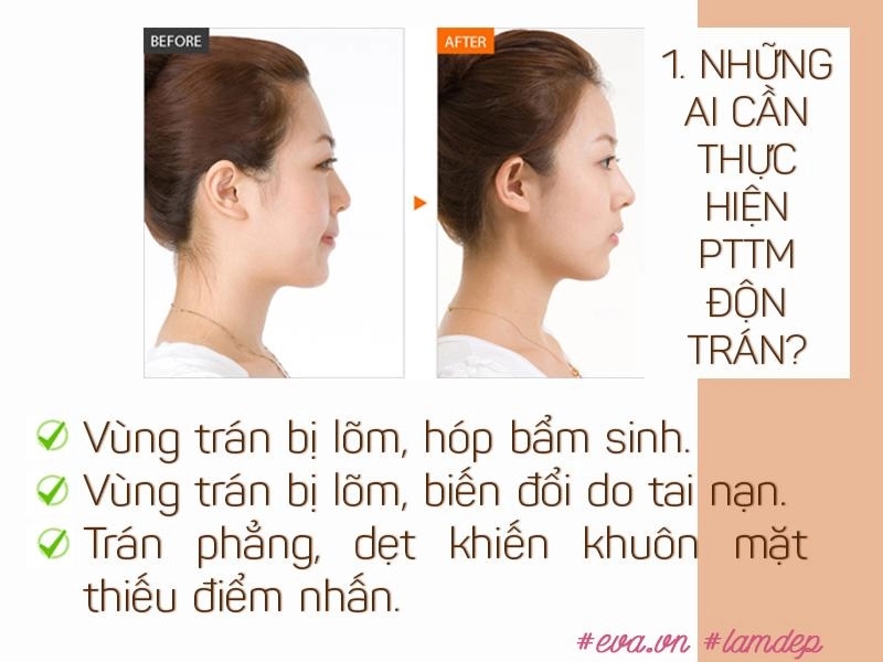 Vừa cải thiện hình dáng trán vừa tạo dáng mũi s-line độn trán thật sự thần kỳ đến vậy