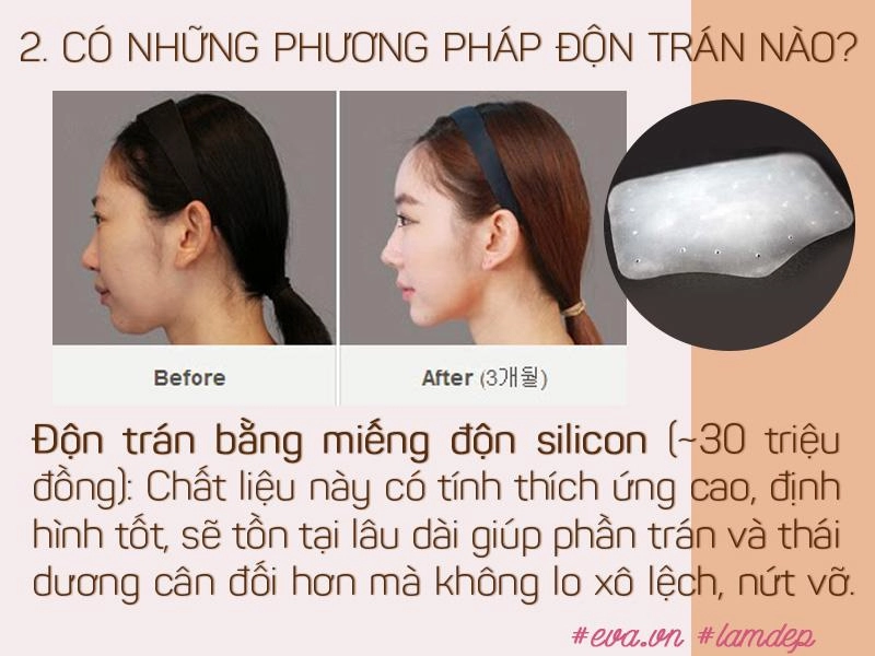 Vừa cải thiện hình dáng trán vừa tạo dáng mũi s-line độn trán thật sự thần kỳ đến vậy