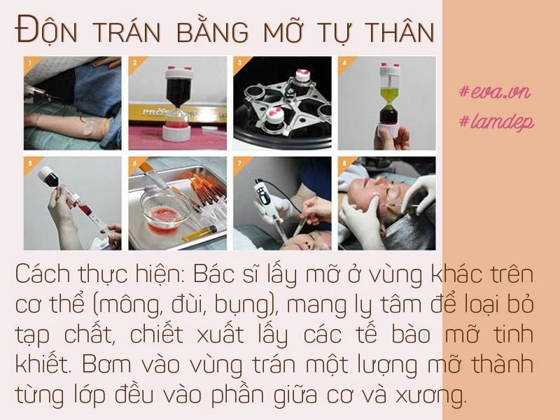 Vừa cải thiện hình dáng trán vừa tạo dáng mũi s-line độn trán thật sự thần kỳ đến vậy