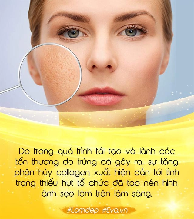 Ai nói trị mụn xong là da auto đẹp thế còn bước hoàn thiện quan trọng này vứt đi đâu