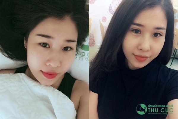 Cả thế giới ra đây mà xem con gái ai cũng cắt mí rồi