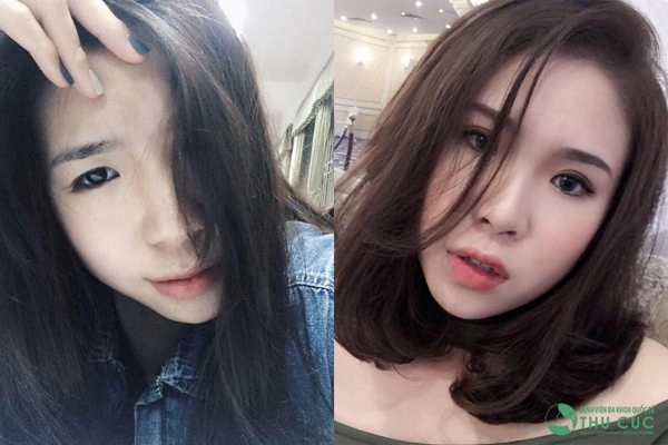 Cả thế giới ra đây mà xem con gái ai cũng cắt mí rồi