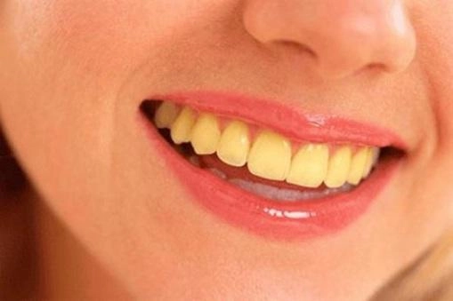 Cao răng mảng bám ố vàng sạch bách với 4 cách làm trắng răng từ 1 quả chanh