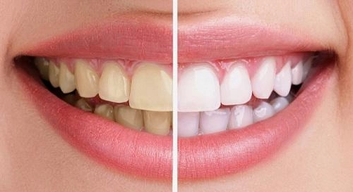 Cao răng mảng bám ố vàng sạch bách với 4 cách làm trắng răng từ 1 quả chanh