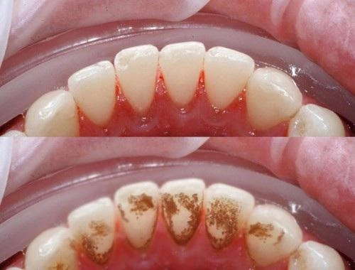 Cao răng mảng bám ố vàng sạch bách với 4 cách làm trắng răng từ 1 quả chanh