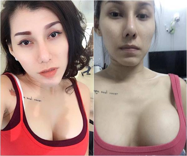 Câu trả lời bất ngờ từ chuyên gia túi ngực có thế bị rách thủng chứ không thể bị nổ