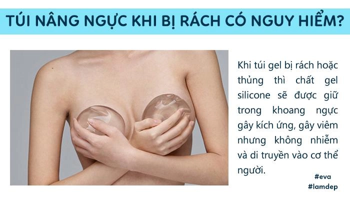 Câu trả lời bất ngờ từ chuyên gia túi ngực có thế bị rách thủng chứ không thể bị nổ