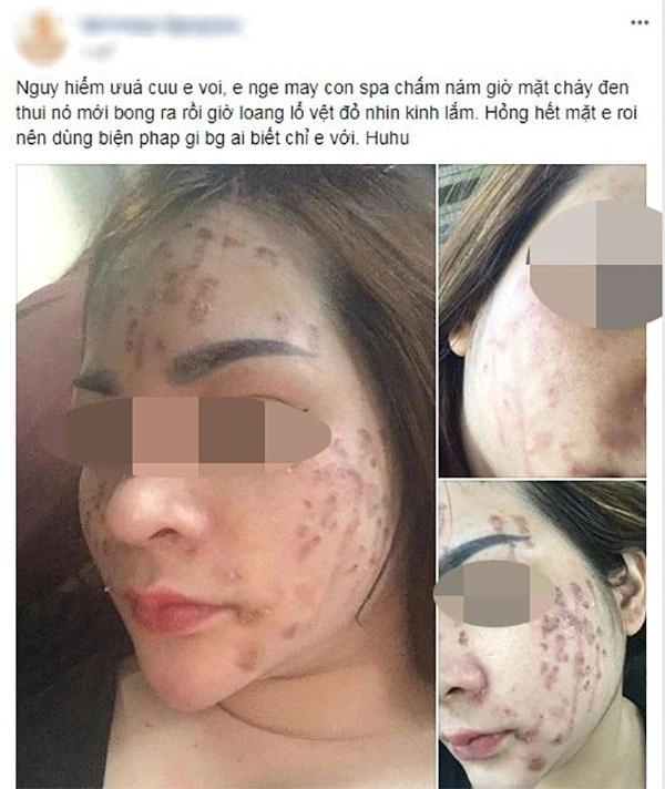 Chấm nám bằng axit phương pháp khiến chị em đang xinh đẹp trở thành thảm họa xấu xí