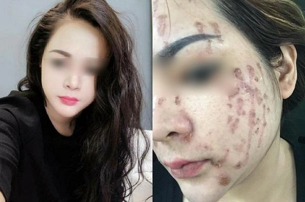 Chấm nám bằng axit phương pháp khiến chị em đang xinh đẹp trở thành thảm họa xấu xí