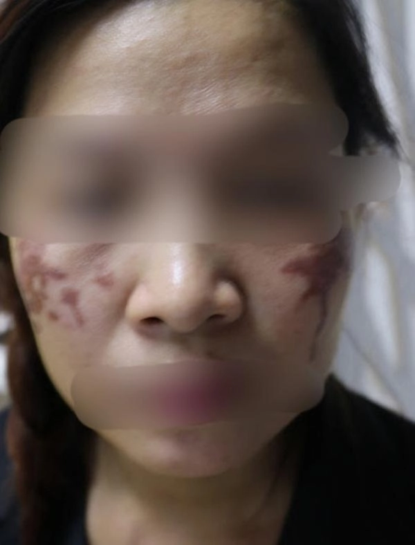 Chấm nám bằng axit phương pháp khiến chị em đang xinh đẹp trở thành thảm họa xấu xí