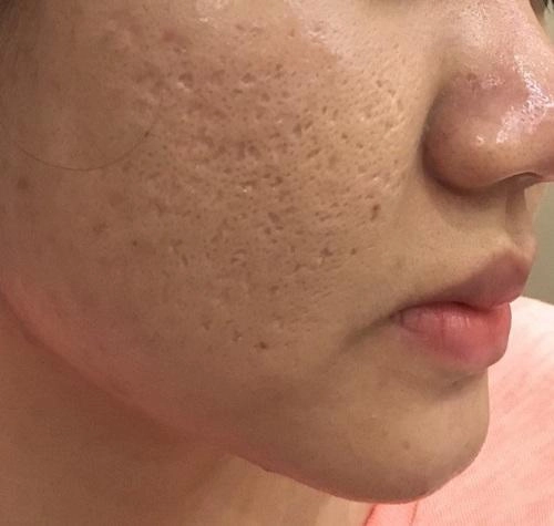 Chạy ra chợ mua nắm rau má về xay nhuyễn rồi đắp lên mặt sẹo lõm đến mấy cũng khỏi