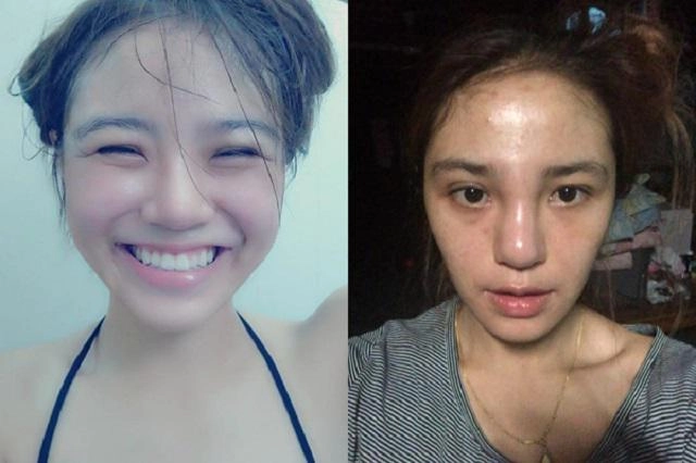 Chi 100 triệu để trùng tu nhan sắc cô gái khóc ròng khi nhận kết quả khủng khiếp