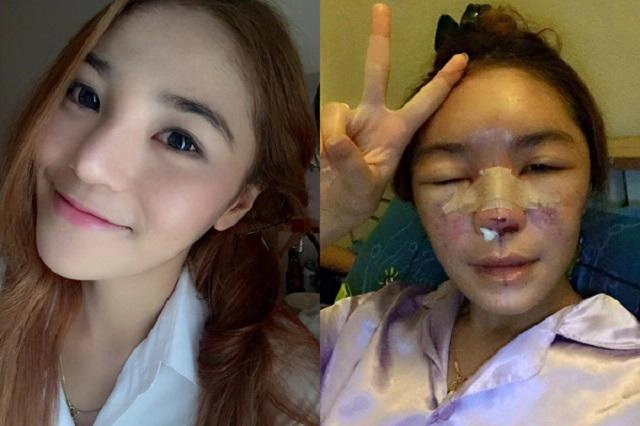 Chi 100 triệu để trùng tu nhan sắc cô gái khóc ròng khi nhận kết quả khủng khiếp