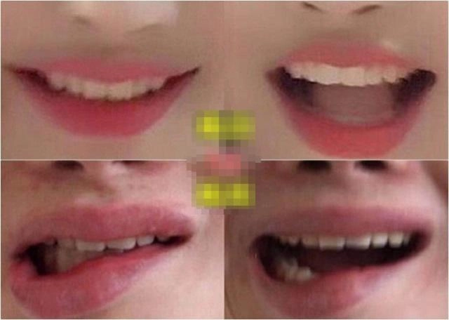Chi 100 triệu để trùng tu nhan sắc cô gái khóc ròng khi nhận kết quả khủng khiếp