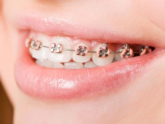 Chị em tuổi băm mà vẫn muốn niềng răng hãy đọc ngay bài viết này