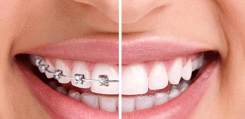 Chị em tuổi băm mà vẫn muốn niềng răng hãy đọc ngay bài viết này