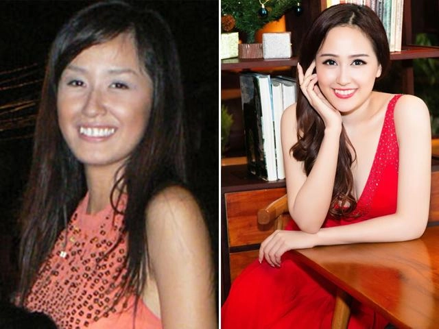 Chị em tuổi băm mà vẫn muốn niềng răng hãy đọc ngay bài viết này