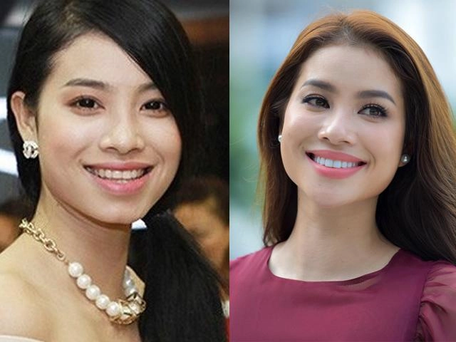Chị em tuổi băm mà vẫn muốn niềng răng hãy đọc ngay bài viết này