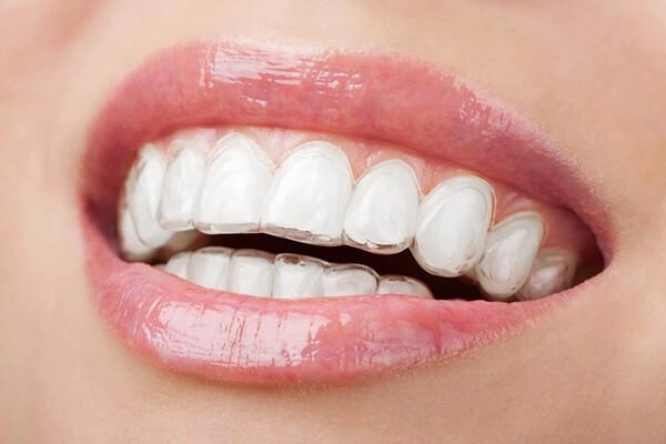 Chị em tuổi băm mà vẫn muốn niềng răng hãy đọc ngay bài viết này