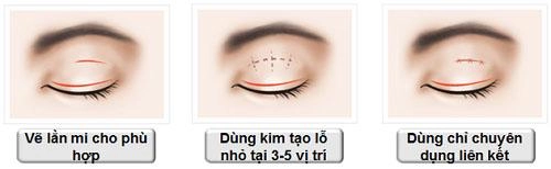Chi tiền và mạo hiểm dao kéo nhưng bạn có biết nhấn mí kéo dài được bao lâu không