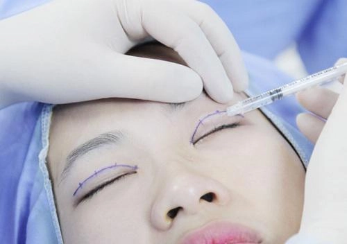 Chi tiền và mạo hiểm dao kéo nhưng bạn có biết nhấn mí kéo dài được bao lâu không