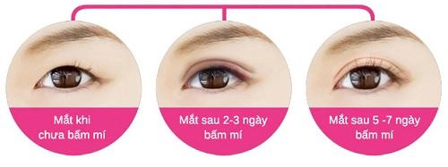 Chi tiền và mạo hiểm dao kéo nhưng bạn có biết nhấn mí kéo dài được bao lâu không