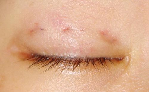 Chi tiền và mạo hiểm dao kéo nhưng bạn có biết nhấn mí kéo dài được bao lâu không
