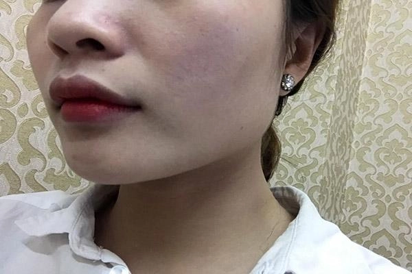 Chiều lòng bạn trai dùng kem trộn cô gái này đã mất 2 năm để phục hồi da của mình