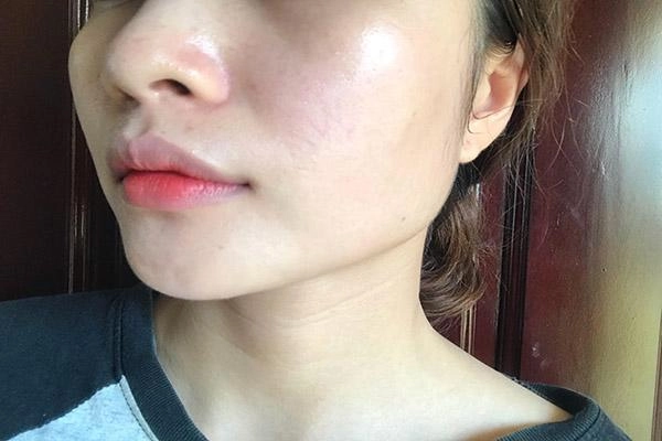 Chiều lòng bạn trai dùng kem trộn cô gái này đã mất 2 năm để phục hồi da của mình