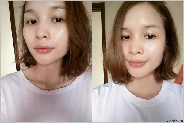 Chiều lòng bạn trai dùng kem trộn cô gái này đã mất 2 năm để phục hồi da của mình