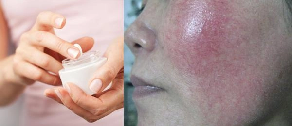 Chiều lòng bạn trai dùng kem trộn cô gái này đã mất 2 năm để phục hồi da của mình