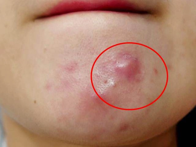 Có ngay 10 cách trị mụn bọc cực dễ ngay tại nhà mà các cô nàng không nên bỏ qua
