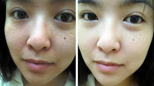 Cứ lấy nhánh gừng băm nhỏ rồi chà lên mặt nám tàn nhang nặng đến mấy cũng khỏi