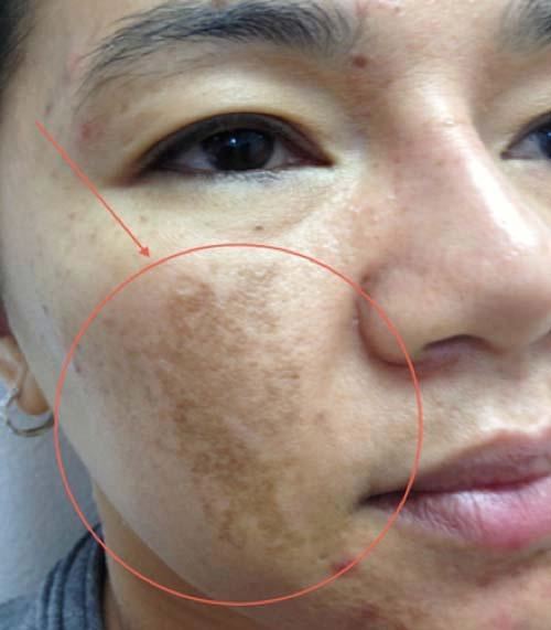 Da đẹp lên trông thấy nhờ cách trị nám mặt bằng mật ong chỉ trong 2 tuần