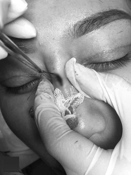 Dân mạng xôn xao trước ca thảm họa thủng da đầu mũi lộ chỉ trắng ngay khi phẫu thuật