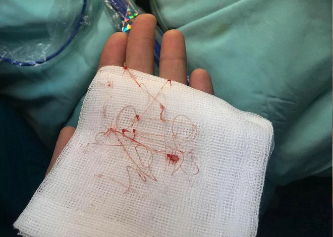 Dân mạng xôn xao trước ca thảm họa thủng da đầu mũi lộ chỉ trắng ngay khi phẫu thuật