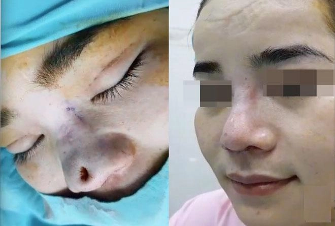 Dân mạng xôn xao trước ca thảm họa thủng da đầu mũi lộ chỉ trắng ngay khi phẫu thuật
