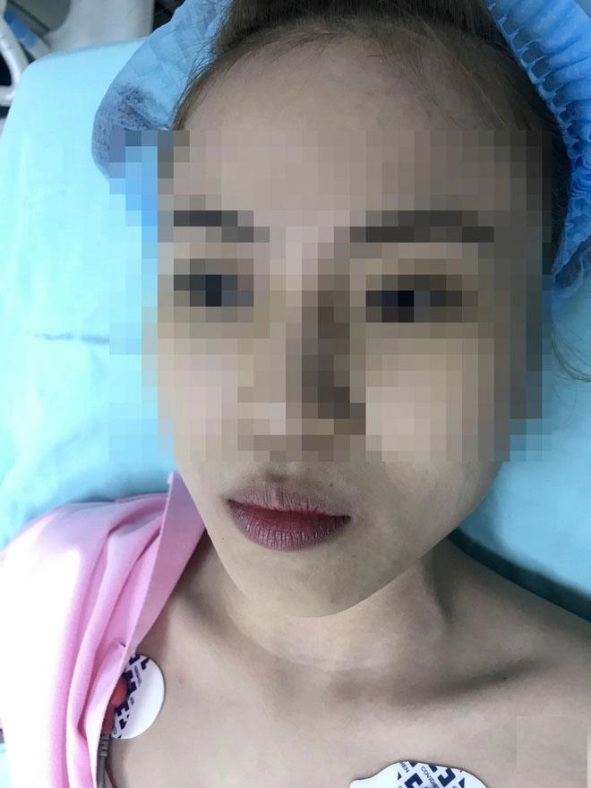 Dân mạng xôn xao trước ca thảm họa thủng da đầu mũi lộ chỉ trắng ngay khi phẫu thuật