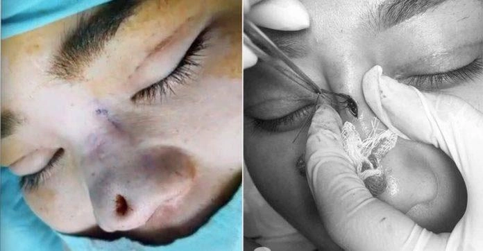 Dân mạng xôn xao trước ca thảm họa thủng da đầu mũi lộ chỉ trắng ngay khi phẫu thuật