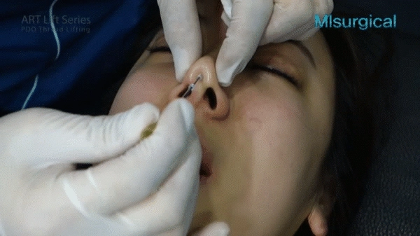 Dân mạng xôn xao trước ca thảm họa thủng da đầu mũi lộ chỉ trắng ngay khi phẫu thuật