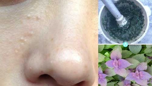 Đây là 3 cách đơn giản rẻ tiền nhất để trị mụn thịt quanh mắt mụn cỡ nào cũng lặn