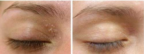 Đây là 3 cách đơn giản rẻ tiền nhất để trị mụn thịt quanh mắt mụn cỡ nào cũng lặn
