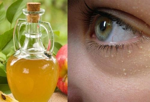 Đây là 3 cách đơn giản rẻ tiền nhất để trị mụn thịt quanh mắt mụn cỡ nào cũng lặn