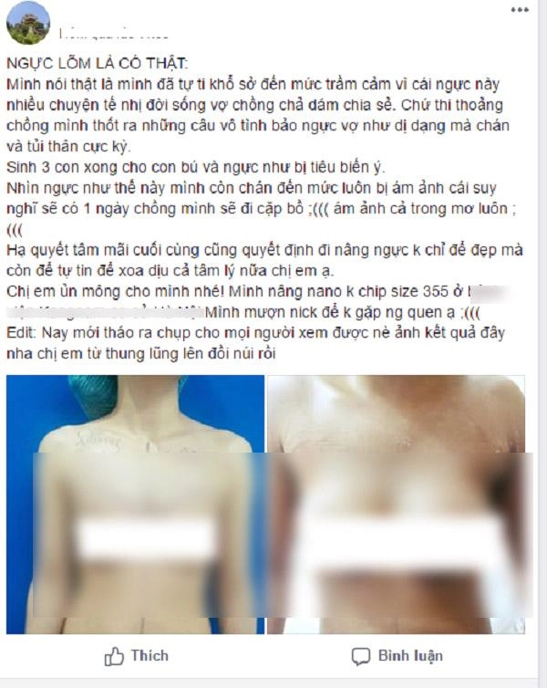 Đẻ 3 con khổ sở khi ngực gần như tiêu biến mẹ bỉm sữa quyết định đụng chạm dao kéo