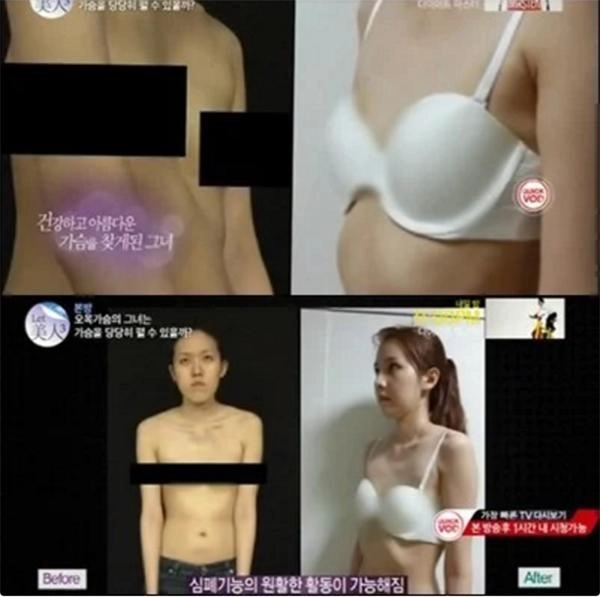 Đẻ 3 con khổ sở khi ngực gần như tiêu biến mẹ bỉm sữa quyết định đụng chạm dao kéo