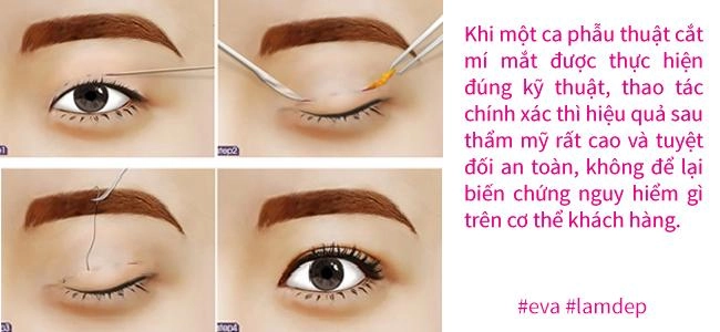 Giải đáp 5 câu hỏi thường gặp khiến chị em băn khoăn trước khi thẩm mỹ mắt