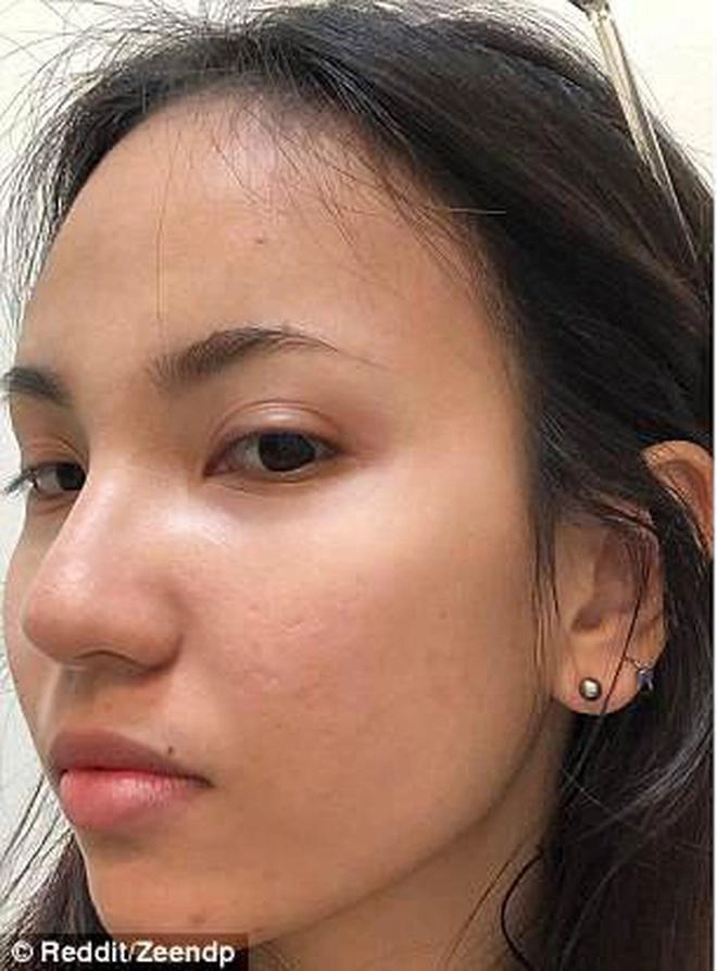 Hành trình trị mụn kiên trì 11 năm của cô gái gốc việt gây chấn động báo nước ngoài