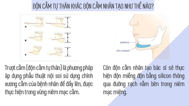 Hết gọt đến độn bằng silicon giờ đây chị em tìm đến phương pháp trượt với chính cằm của mình